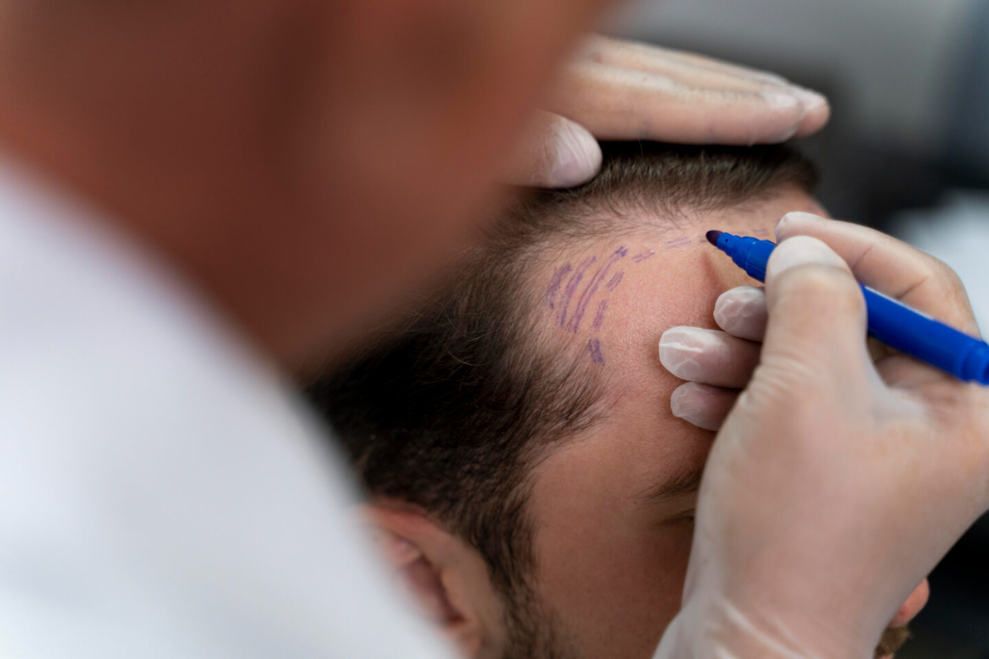 Hair Transplant Process: 6 Things to Note