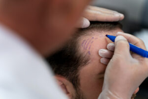 Hair Transplant Process: 6 Things to Note