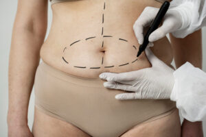 Abdominoplasty