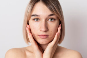 Acne Scars Don’t Have to Be Forever: What You Can Do Today