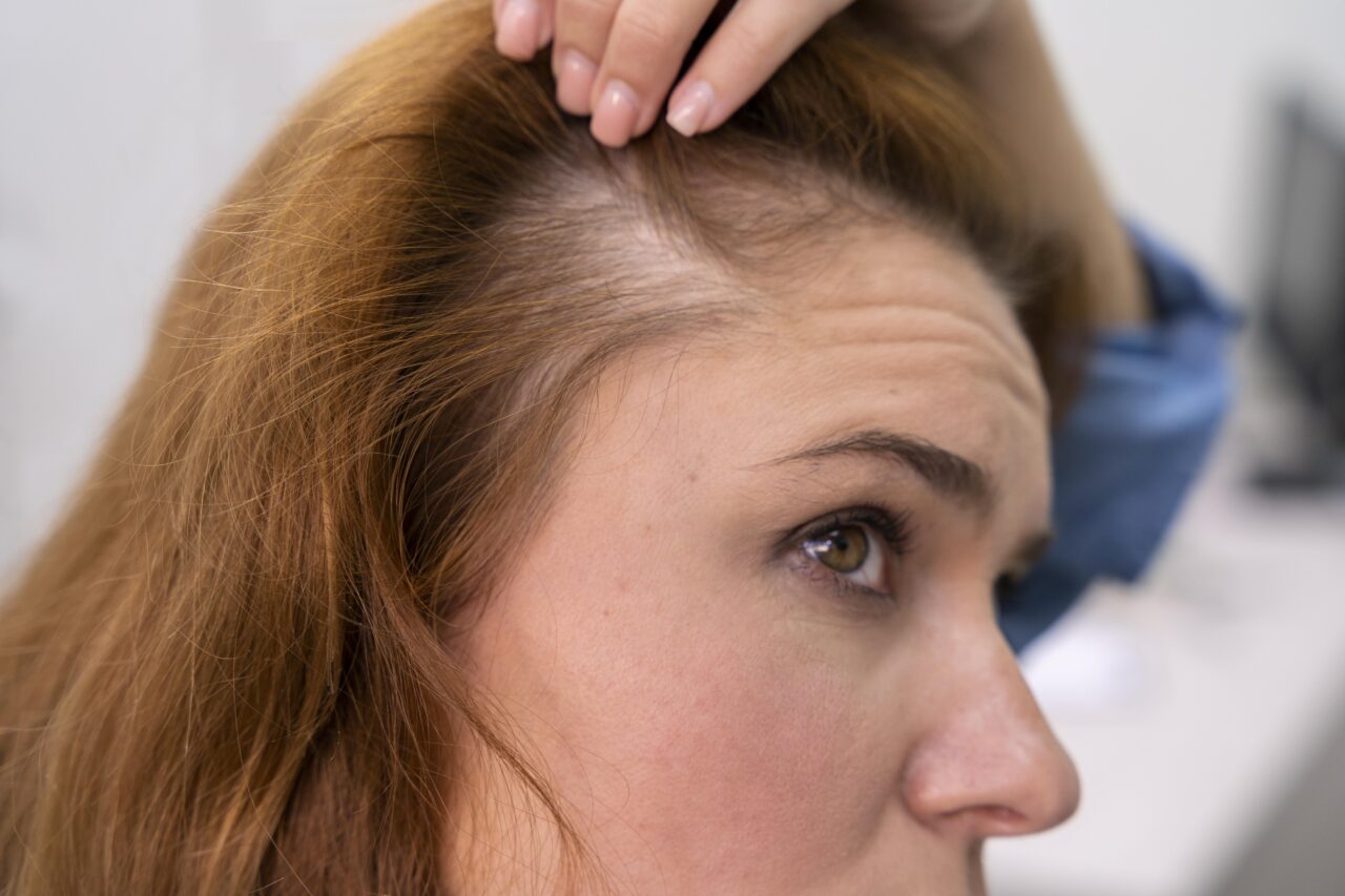Can Hair Replacement Restore More Than Just Your Hair